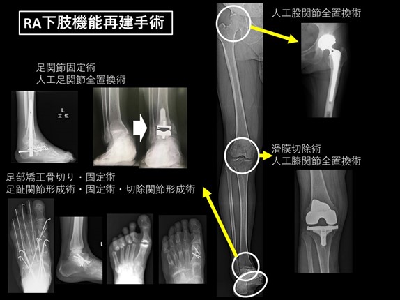 各部位におけるRA機能再建手術